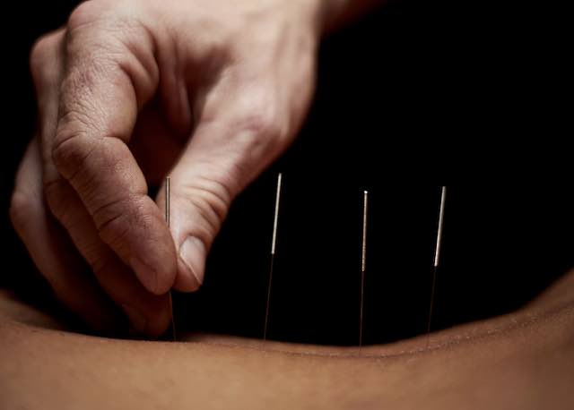 Acupuncture
